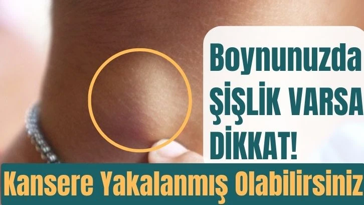 Boynunuzda Şişlik Varsa  Dikkat!  Kansere Yakalanmış Olabilirsiniz