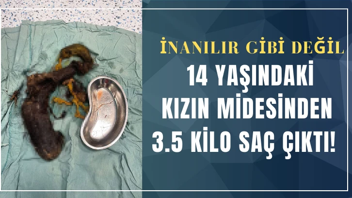 İnanılır Gibi Değil! 14 Yaşındaki Kızın Midesinden 3.5 Kilo Saç Çıktı! 