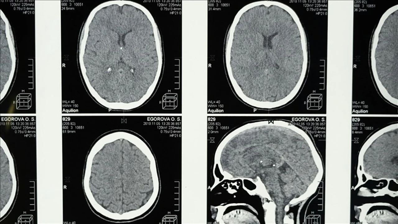 Uykunun REM evresine geçişte zorlanmak Alzheimer belirtisi olabilir